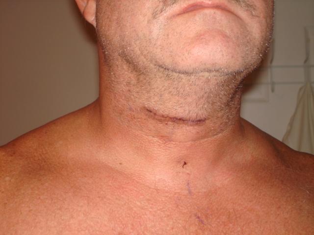 Attached picture 6212318-CERVICALFUSIONSCARS-2DAYSLATERATHOME!001(Small).jpg